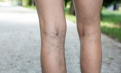 Οι λόγοι για την ανάπτυξη κινεζικών φλεβών στις γυναίκες