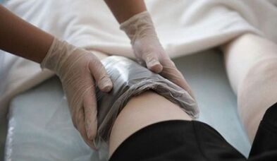 Οι μέθοδοι των ανθρώπων για τη θεραπεία των κιρσών στις γυναίκες
