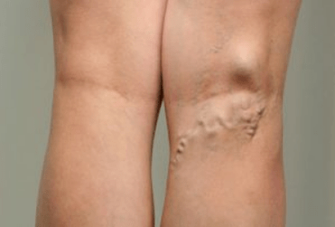 Διάγνωση κιρσών σε έγκυες γυναίκες