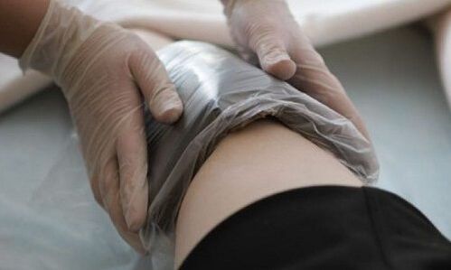 Αντιμετώπιση κιρσών με κομπρέσες